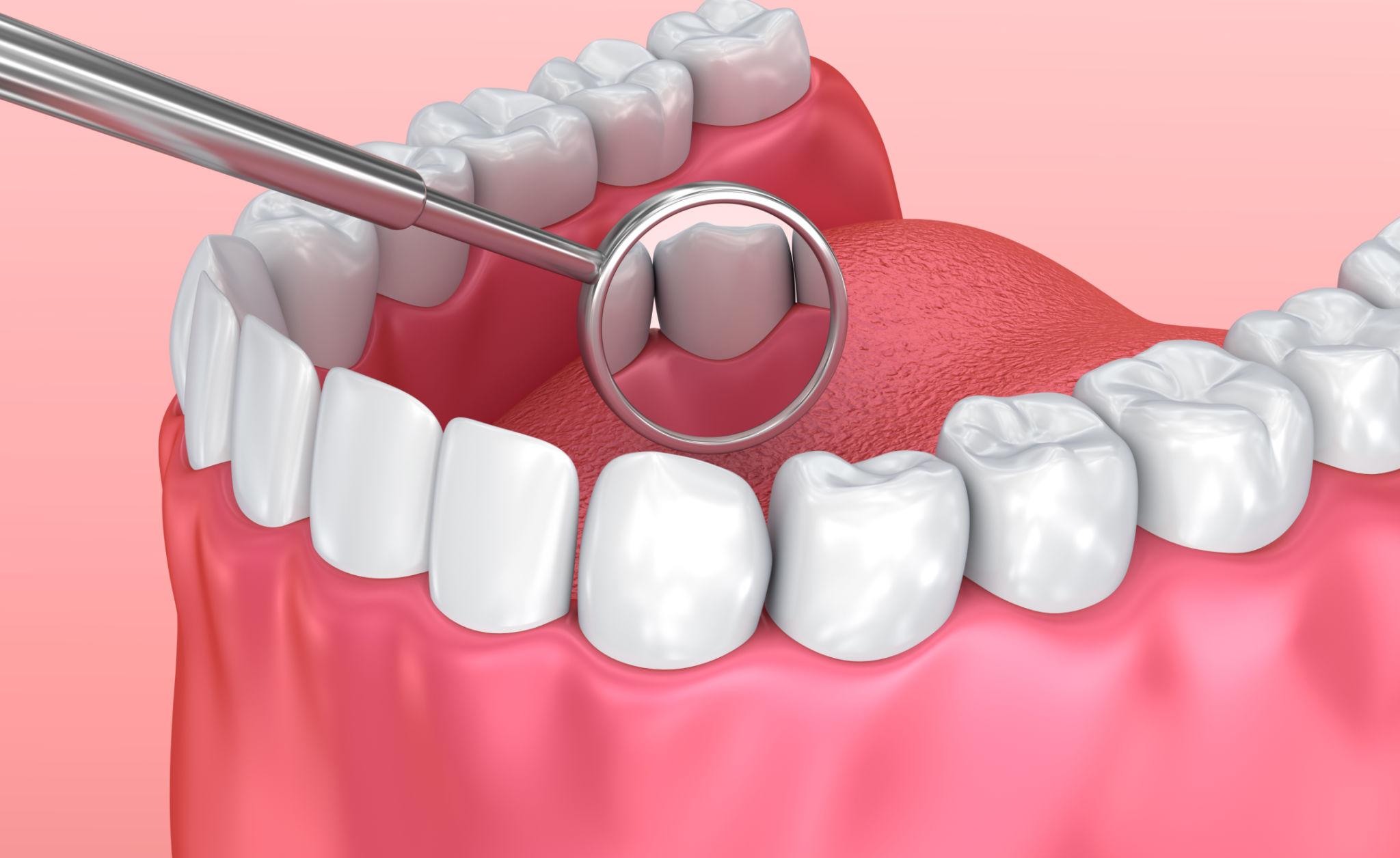 Dental Checkup